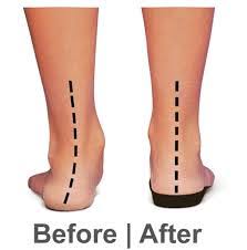 Picture of orthotics correcting leg alignment